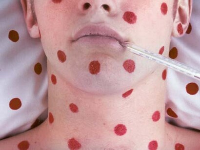 Malattie contagiose?