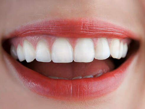 A woman smiling. It is critical that you brush and floss properly after your scaling to prevent plaque from forming again in the same areas