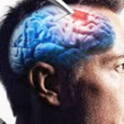 Para reducir la probabilidad de retracción del hilo en nuestro segundo participante, implementamos una serie de mitigaciones, incluida la reducción del movimiento cerebral durante la cirugía y la reducción del espacio entre el implante y la superficie del cerebro