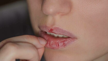 A person picking at their lips compulsively is a sign of dermatillomania