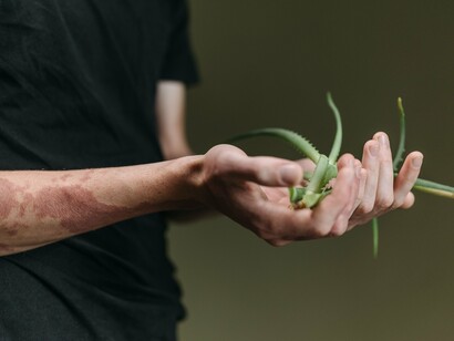 A person with visible skin condition grasping an aloe vera plant, reflecting the soothing qualities associated with this versatile houseplant