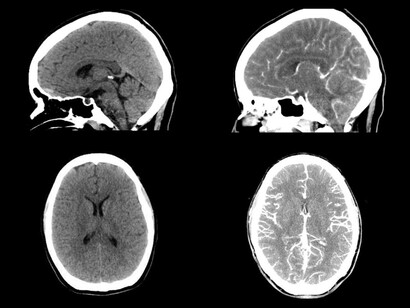 Una persona con parkinsonismo generalmente comienza a desarrollar síntomas entre los 50 y los 80 años