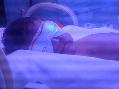 Fototerapia per neonati prematuri