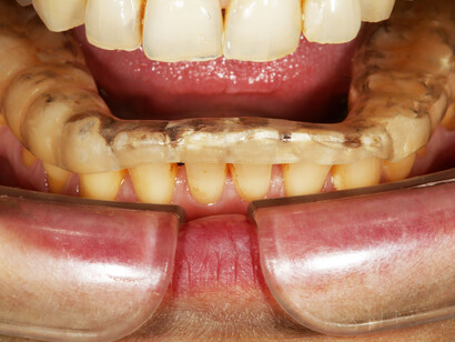 Bite. Detto anche ortotico o splint occlusale. Un dispositivo la cui facilità, al limite della banalità, nel procedimento di costruzione è direttamente proporzionale alla difficoltà e complessità nella registrazione della posizione con cui si dovranno incastrare i denti. Una fase in cui c’è tutta la storia e la competenza di un dentista. Se realizzato correttamente può risolvere molti problemi.