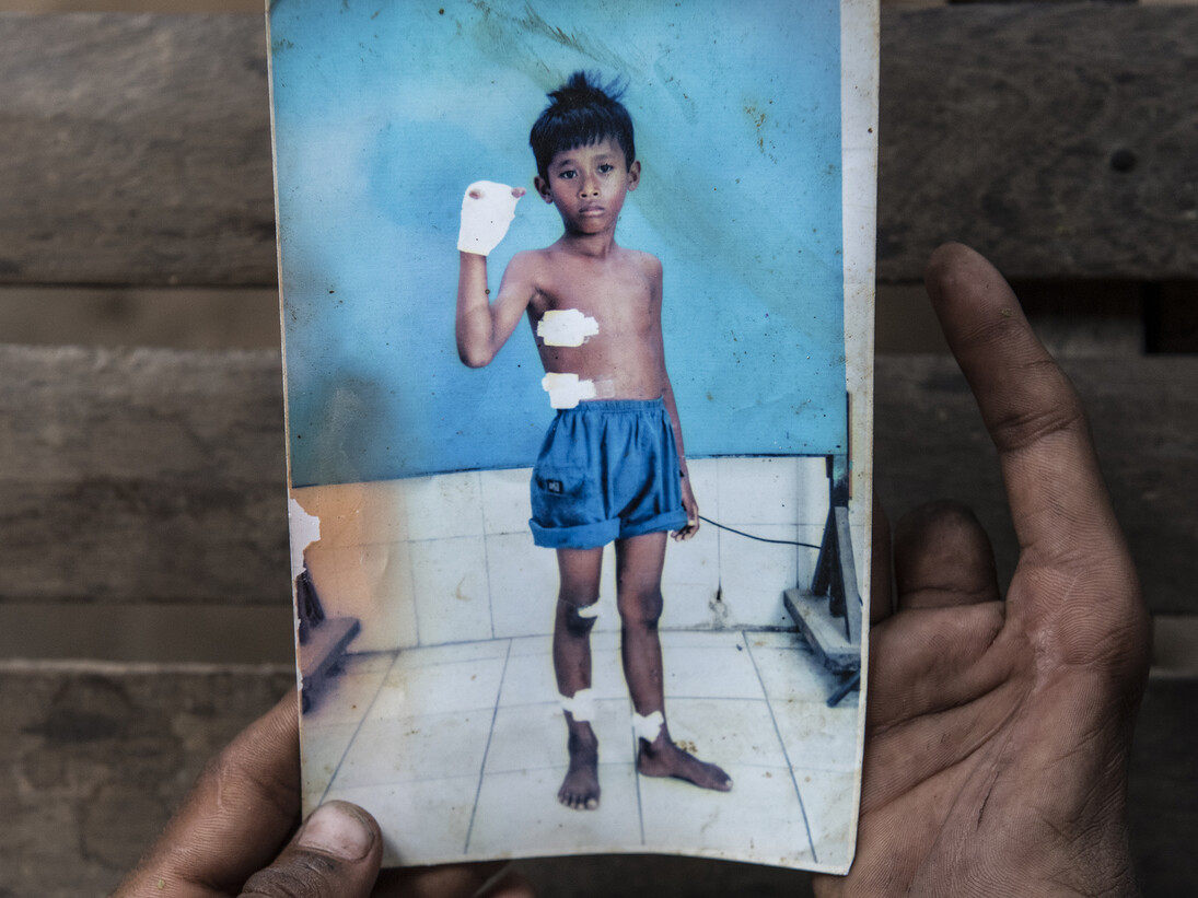 Te Denar (10) at home holds a photograph of himself, He sustained his injuries
when the fuse of a mortar round ignited whilst he was holding it. Denar found the
fuse in Kampong Thom Province, Cambodia, whilst out playing with his cousins
building a dam. His brother took the photograph to show to NGO’s in the hope
that one of them could help in anyway but did not know how to go about asking