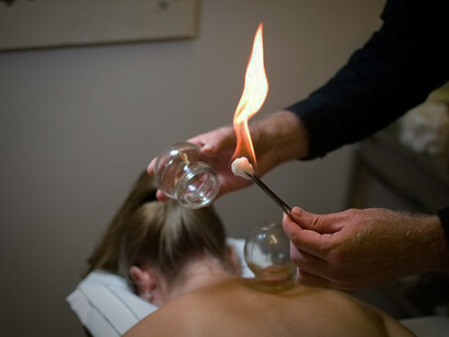 Cupping therapy