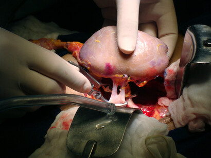 Transplante de riñón