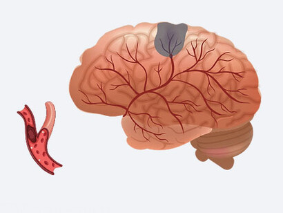 CVA isquémico; es el accidente cerebrovascular más común. Sucede cuando un vaso sanguíneo del cerebro se obstruye por  un coágulo o trombo. La presión arterial alta es uno de los principales factores de riesgo de un ataque cerebral isquémico