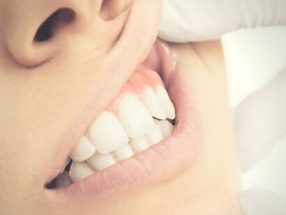 Controllare le malocclusioni dentali