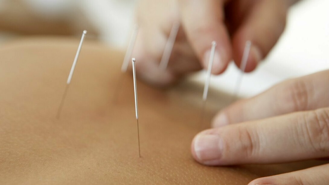 Acupuncture