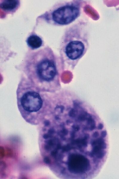 Infección por cetomegalovirus