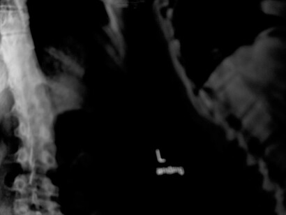 Radiografía