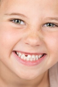 A little girl affected by hypodontia