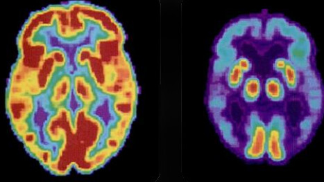 Desentrañando el misterio. Tomografías por emisión de positrones (PET) que muestran las diferencias entre el cerebro de una persona mayor sana —izquierda— y el de una persona mayor que padece la enfermedad de Alzheimer