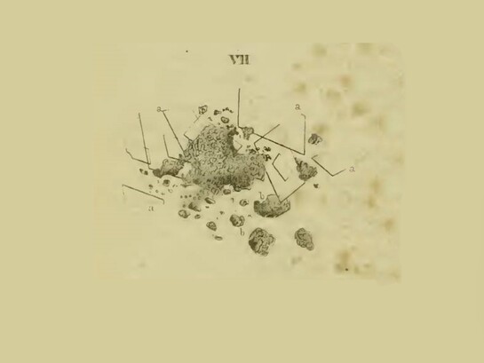 Riproduzione dell'aspetto microscopico del materiale ateromatoso nelle tavole del libro di Jiulius Vogel "Icones Histologiae Pathologicae", 1843