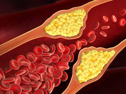 Arteria ostruita, colpita da colesterolo