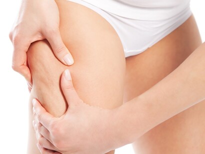 La aparición de la celulitis