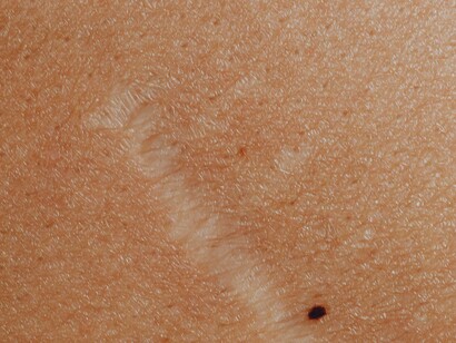 Scar and mole on skin