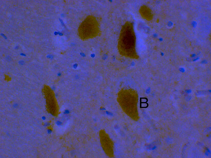 Sustancia negra con pérdida de células y patología con cuerpos de Lewy