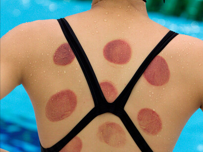 Benefits of Cupping Therapy for Athletes