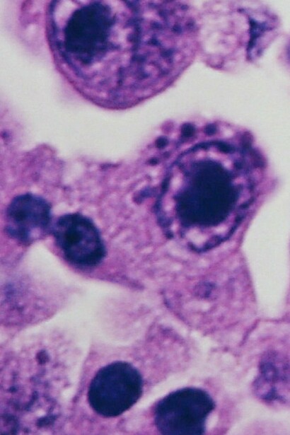 Infección por cetomegalovirus