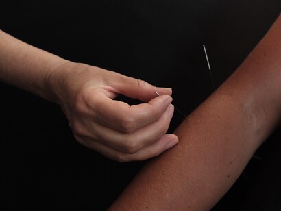 Needling sensation