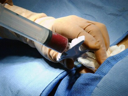 Extracción de células de médula ósea