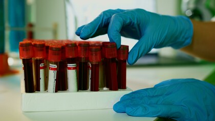 Medicina preditiva é o campo da saúde que busca antever doenças antes que se desenvolvam, usando marcadores biológicos, ambientais, epigenéticos e genéticos. Seu objetivo não é apenas diagnosticar precocemente, mas principalmente estimar o risco individual de desenvolver certas condições ao longo da vida. Trata-se de um modelo que antecipa, em vez de apenas reagir. Nesse contexto, os testes genéticos despontam como uma das ferramentas mais promissoras. Eles analisam sequências específicas do DNA em busca de variantes associadas a doenças hereditárias, como câncer de mama, Alzheimer, doenças cardiovasculares, diabetes tipo 2, entre outras