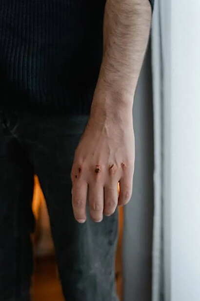 Close-up image of an injured hand, tightly clenched in a fist