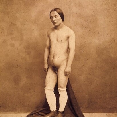 Intersexualidad o hermafroditismo según Nadar