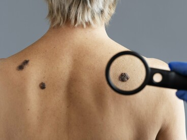 Dark, irregular moles visible across a person’s back, representing potential warning signs of melanoma