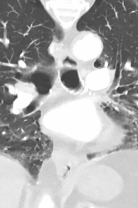 Neumonía causada por el COVID-19