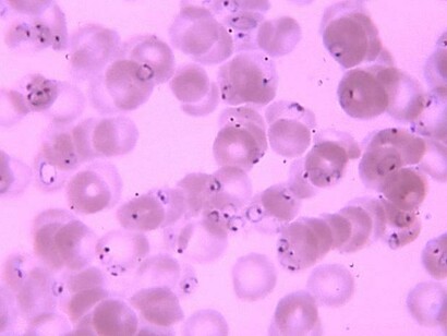 Patógeno de la malaria en sangre