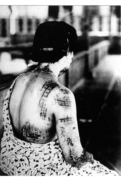 Gonichi Kimura, Kimono patterns burnt into the skin, First military hospital, Hiroshima, circa August 15th, 1945, photograph Hiroshima, Hiroshima Peace Memorial, © Photograph by Gonichi Kimura, Courtesy of Hiroshima Peace Memorial Museum