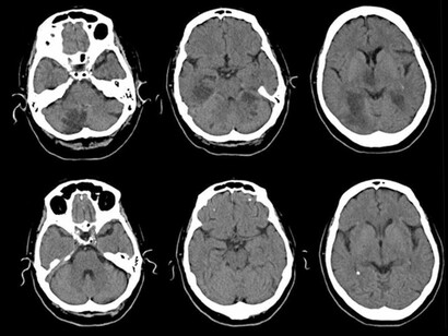 Debido a que el parkinsonismo no responde a los tratamientos típicos utilizados en la EP y al hecho de que puede presentar una extensa variedad de síntomas, a menudo es difícil llegar a un diagnóstico rápido