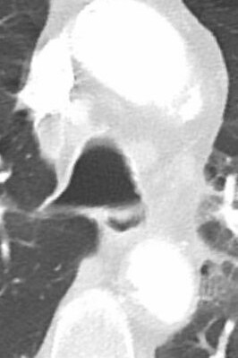 Neumonía causada por el COVID-19