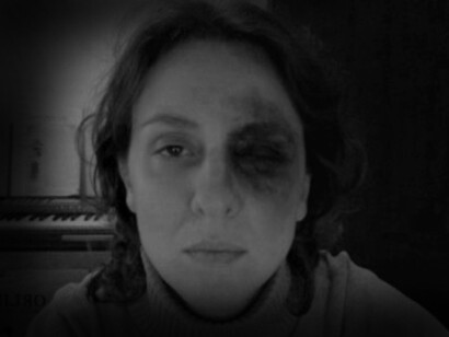 Ester Quintana, de 42 años, herida por una bola de goma durante las manifestaciones del 15-M