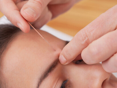 I benefici dell'agopuntura
