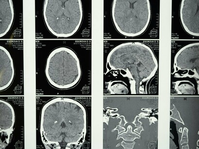 O diagnóstico correto entre tremor essencial e tremor parkinsoniano é crucial para o manejo adequado. Além da avaliação clínica detalhada, os neurologistas podem utilizar testes de função neurológica, exames de neuroimagem, como ressonância magnética, para descartar outras causas. Em alguns casos, exames de medicina nuclear, como SPECT ou PET, para avaliar a função dopaminérgica no cérebro

