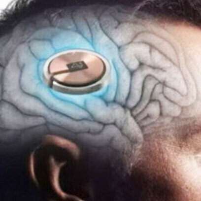 La tecnología de Neuralink funciona a través de un dispositivo del tamaño de cinco monedas apiladas que se coloca dentro del cerebro humano mediante cirugía invasiva