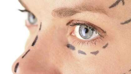El rostro de una mujer con las marcas para realizar la cirugía plástica