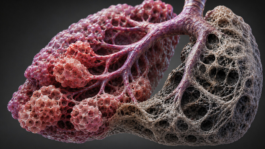 Das erste Medikament, das vollständig durch generative künstliche Intelligenz entdeckt und entwickelt wurde, zielt auf die idiopathische Lungenfibrose ab und hat erfolgreich den Sprung in multiregionale klinische Phase-2-Studien geschafft. Bild: Stark vergrößerter Ausschnitt des Lungengewebes. Die rechte Bildhälfte zeigt die für die idiopathische Lungenfibrose (IPF) charakteristischen fibrotischen Umbauprozesse mit ausgeprägter Vernarbung und Zerstörung der Alveolarstruktur
