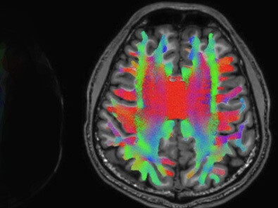El Proyecto del Conectoma Humano (HCP) fue un estudio colaborativo destinado a cartografiar las conexiones del cerebro humano sano