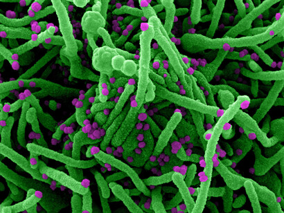 Micrografía electrónica de barrido coloreada de una célula (verde) infectada con partículas del virus SARS-COV-2 (violeta), aislada de una muestra de un paciente enfermo