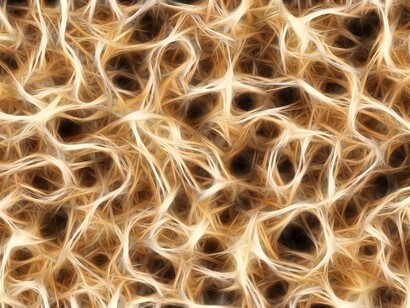 Durante el desarrollo de la enfermedad mueren neuronas y se atrofian diferentes zonas del cerebro