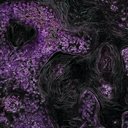 Es gibt viele Arten von Immuntherapien, die zur Behandlung und möglicherweise Heilung einiger Krebsarten eingesetzt werden
