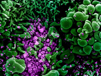 Micrografía electrónica de barrido coloreada de una célula apoptótica (verde) fuertemente infectada con partículas virales del SARS-CoV-2 (violeta), aislada de una muestra de un paciente enfermo