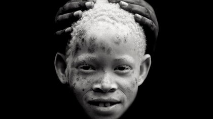  Menina albina. Foto: Eric Lafforgue