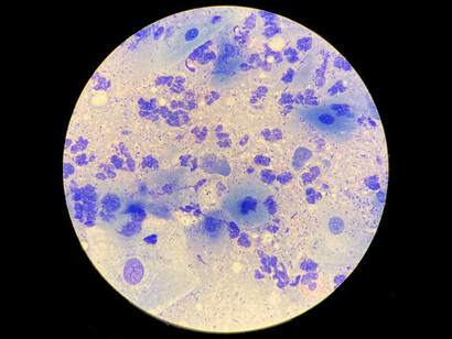 Tinción de Gram de Chlamydia pneumoniae. Muchas infecciones hospitalarias surgen por la transferencia accidental de microorganismos entre pacientes y superficies