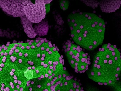 Nobel corona virus coloreada de una célula apoptótica (verde) fuertemente infectada con partículas del virus SARS-COV-2 (violeta), aislada de una muestra de un paciente enfermo